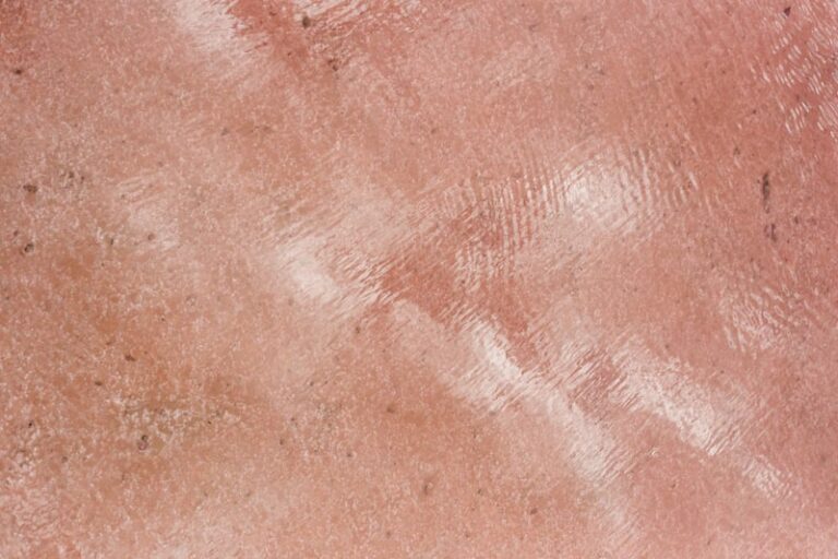Adenoid Type: Understanding Aggressive Skin Pathology