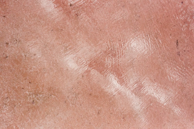 Adenoid Type: Understanding Aggressive Skin Pathology