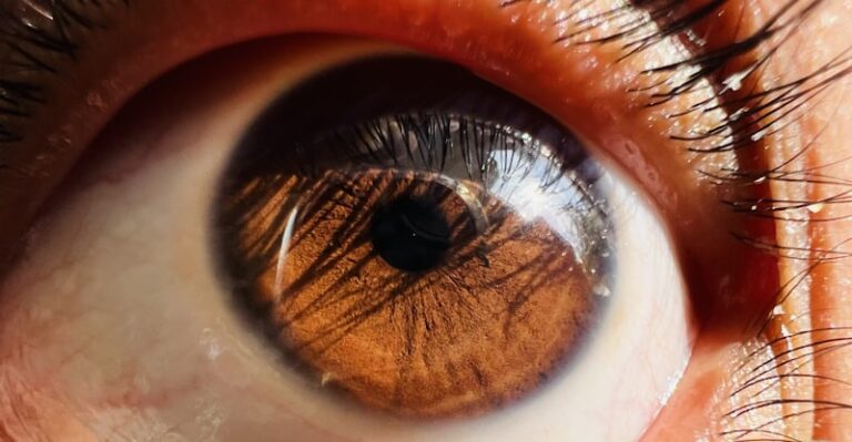 Adie's Syndrome: Decoding the Mystery of the Tonic Pupil
