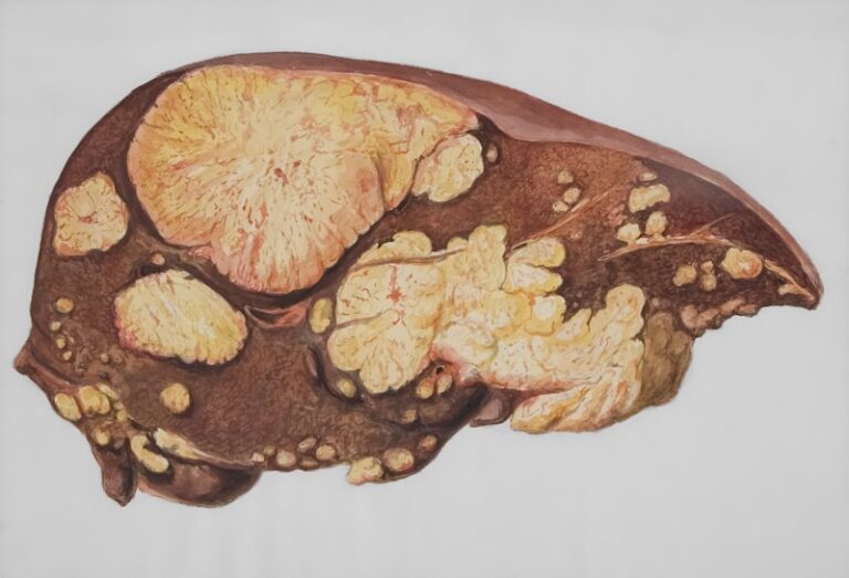 Brown Adipose Tissue: The Hidden Key to Metabolic Health