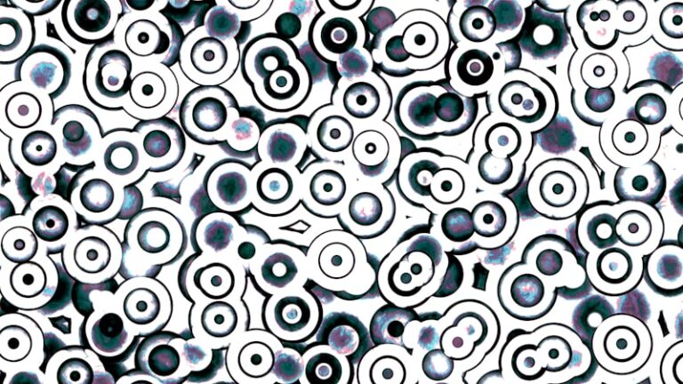 Paracentral Scotoma: Decoding Hidden Visual Blind Spots