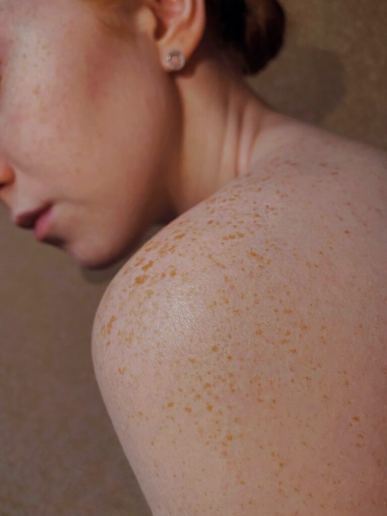 Dermatographism: The Skin’s Physical Reaction to Stress