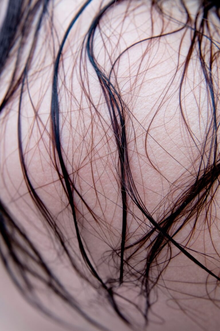 Trichotillomania: Breaking the Cycle of Hair Pulling