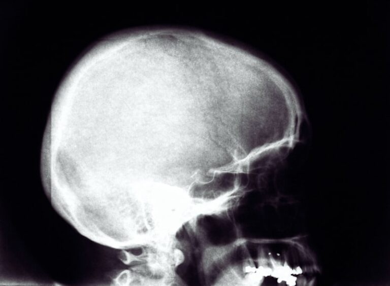 Cebocephaly: Understanding Rare Craniofacial Anomalies