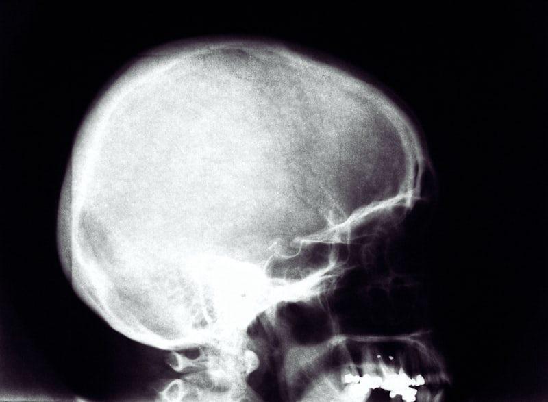 Cebocephaly: Understanding Rare Craniofacial Anomalies