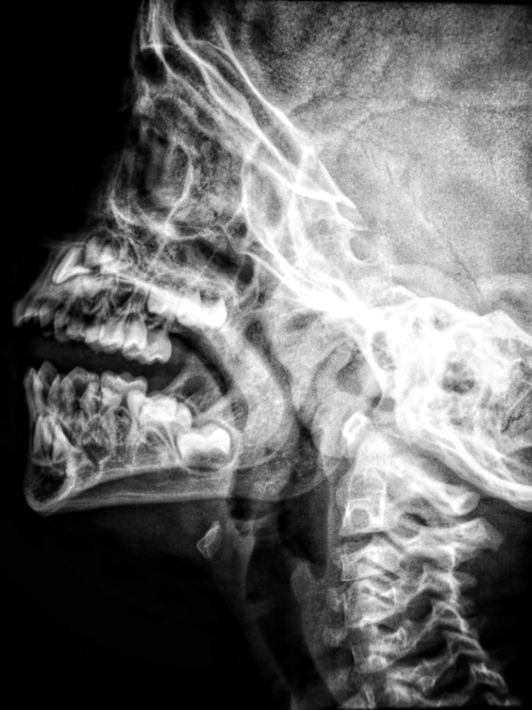 TMJ Disorders: The Mind-Body Connection to Jaw Pain