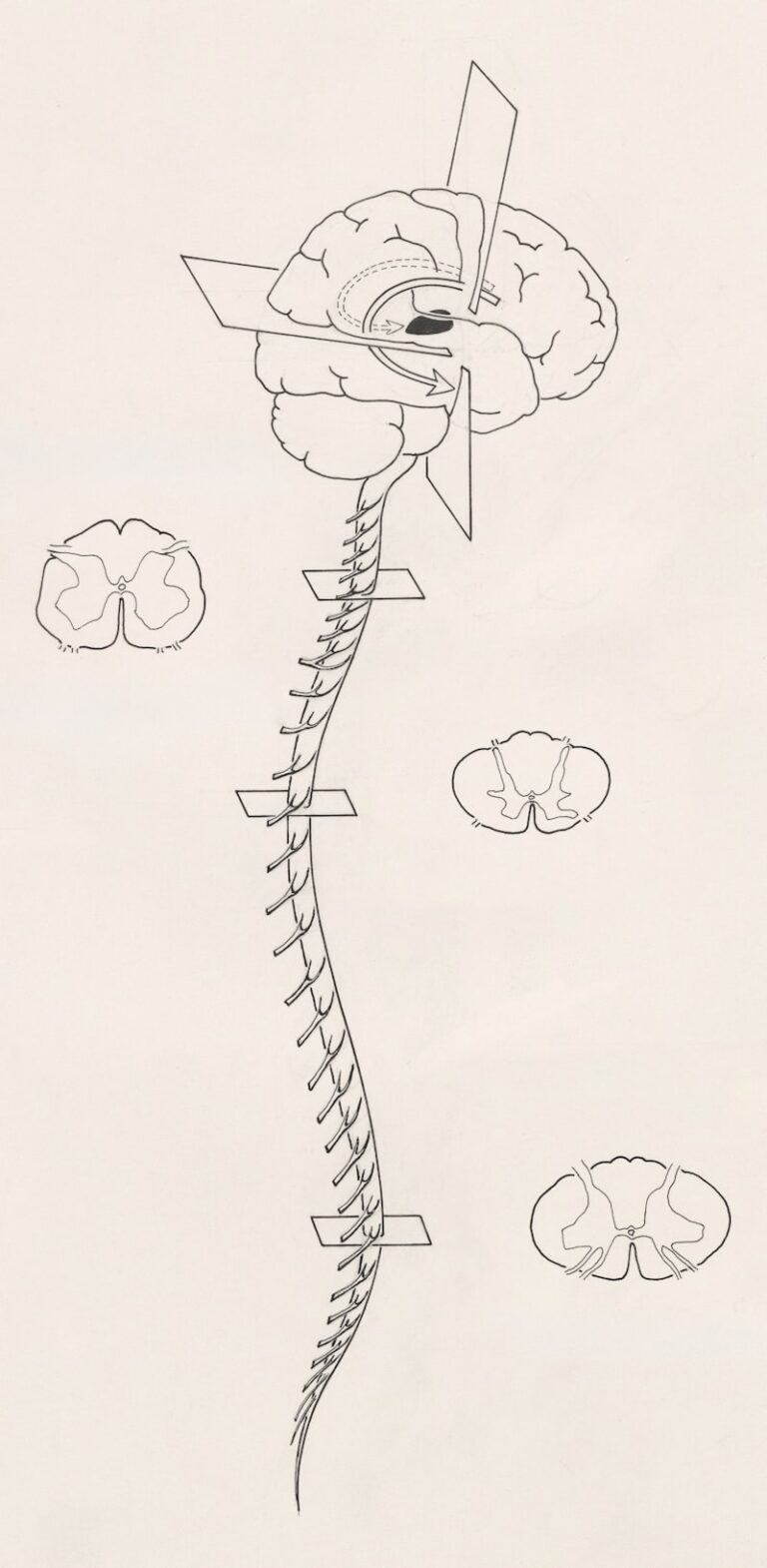 Autonomic Dysreflexia: Taming the Nervous System’s Storm