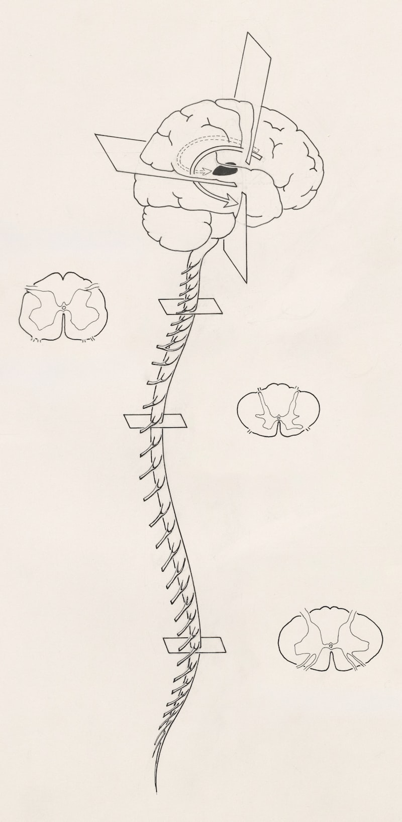 Autonomic Dysreflexia: Taming the Nervous System’s Storm