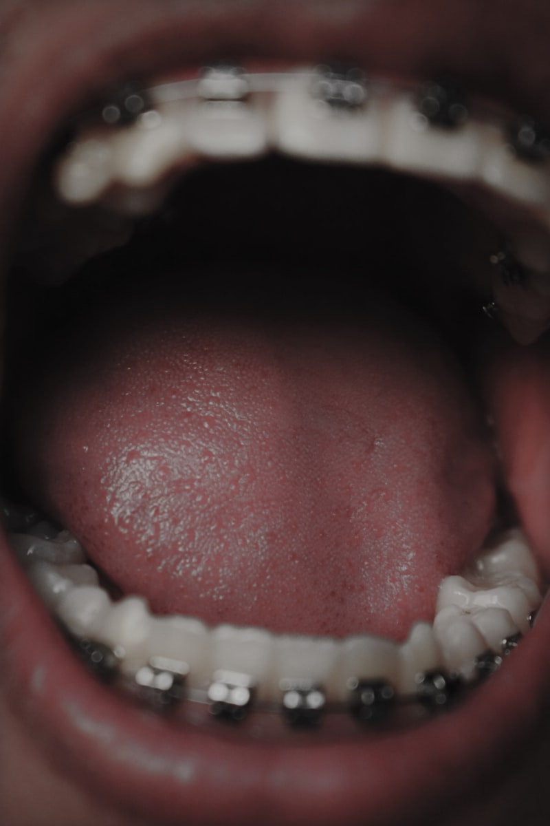 Bruxism: Unlocking the Mind-Body Connection to Teeth Grinding