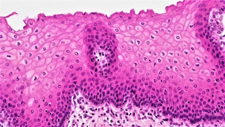 Dermatopathology: Decoding Aggressive Skin Cell Patterns