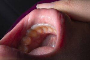 Microglossia: Rare Oral Development and Its Impact