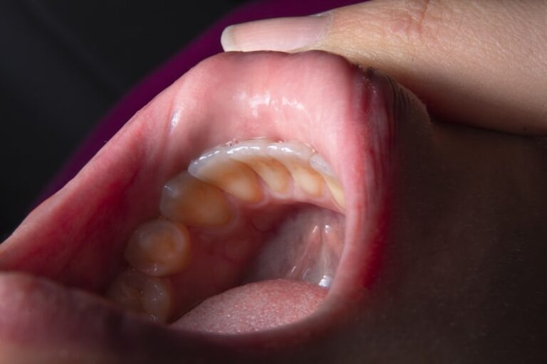Microglossia: Rare Oral Development and Its Impact