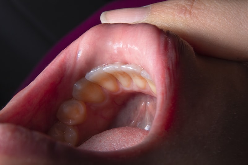 Microglossia: Rare Oral Development and Its Impact