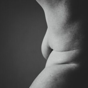 Body Image: Navigating Life with Partial Lipodystrophy
