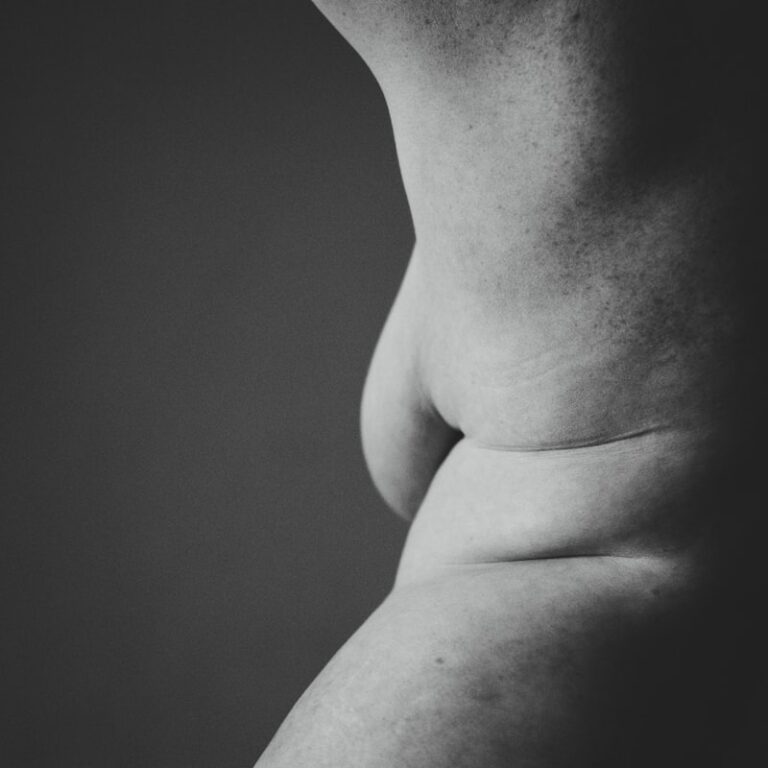 Body Image: Navigating Life with Partial Lipodystrophy
