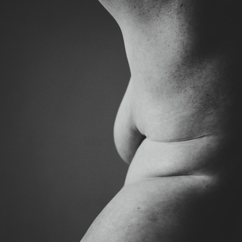 Body Image: Navigating Life with Partial Lipodystrophy