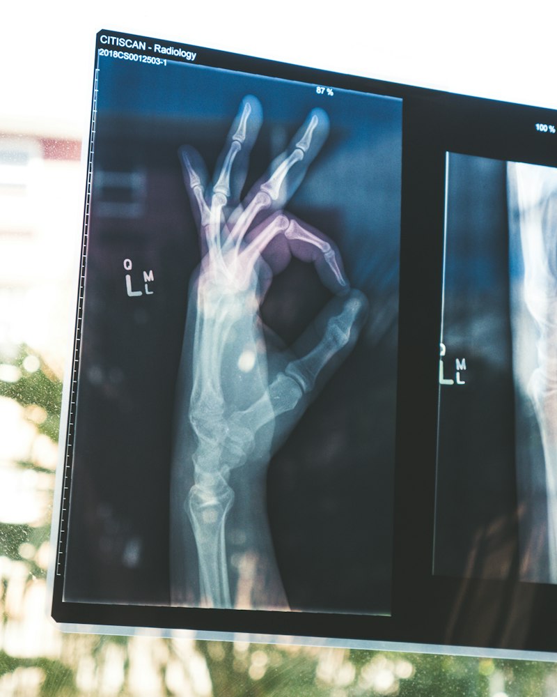 Bone Development: Understanding Localized Anomalies
