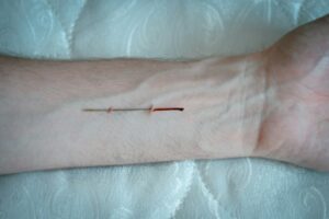 Applied Tension: Master Your Fear of Needles and Blood