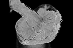 Cornelia de Lange Syndrome: Decoding a Complex Diagnosis