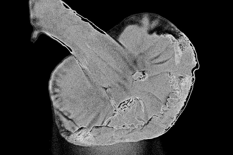 Cornelia de Lange Syndrome: Decoding a Complex Diagnosis