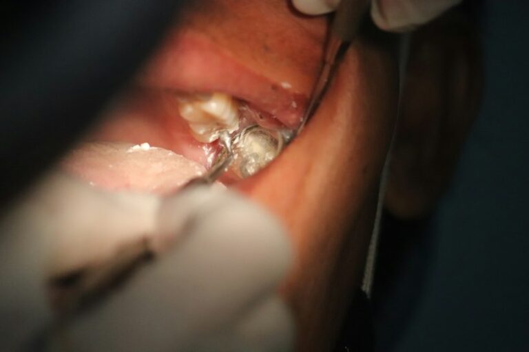 Morsicatio Buccarum: Stop the Cycle of Chronic Cheek Biting