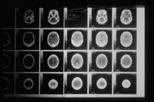 Neuropsychology: Healing the Mind After Radiation Trauma