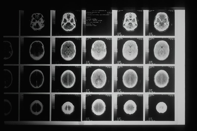 Neuropsychology: Healing the Mind After Radiation Trauma