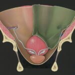 Paruresis: Overcoming the Bashful Bladder