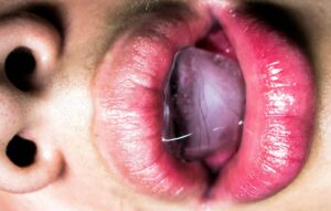 Sialorrhea: The Hidden Psychology of Excessive Drooling